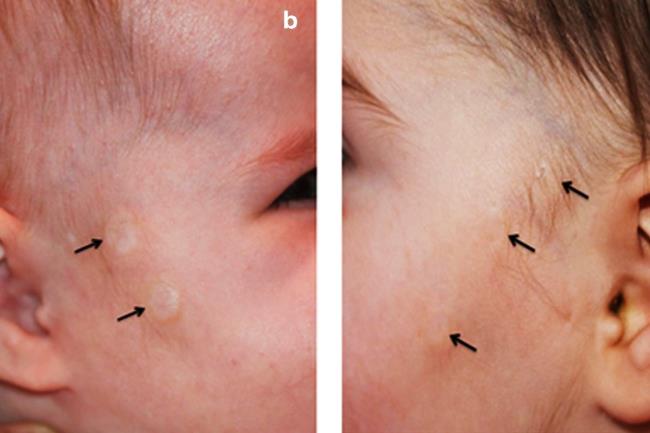 30-facts-a<em></em>bout-focal-dermal-hypoplasia