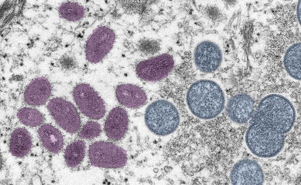 An electron microscopic image of mpox virus particles. The mpox emergency of last summer is over. Was it a passing threat