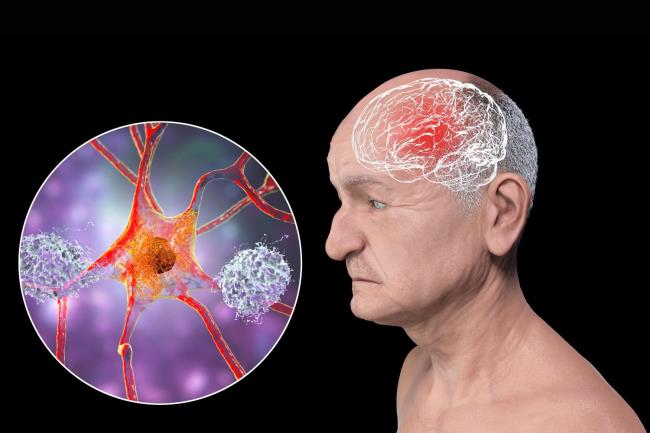 50-facts-a<em></em>bout-parkinsonism